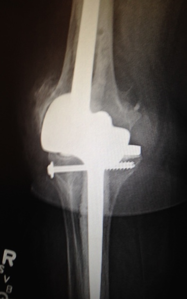Link Endo Rotational Knee (Implant 1509111)
